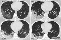 一些幸存下来的COVID-19患者可能会遭受持续的肺损伤